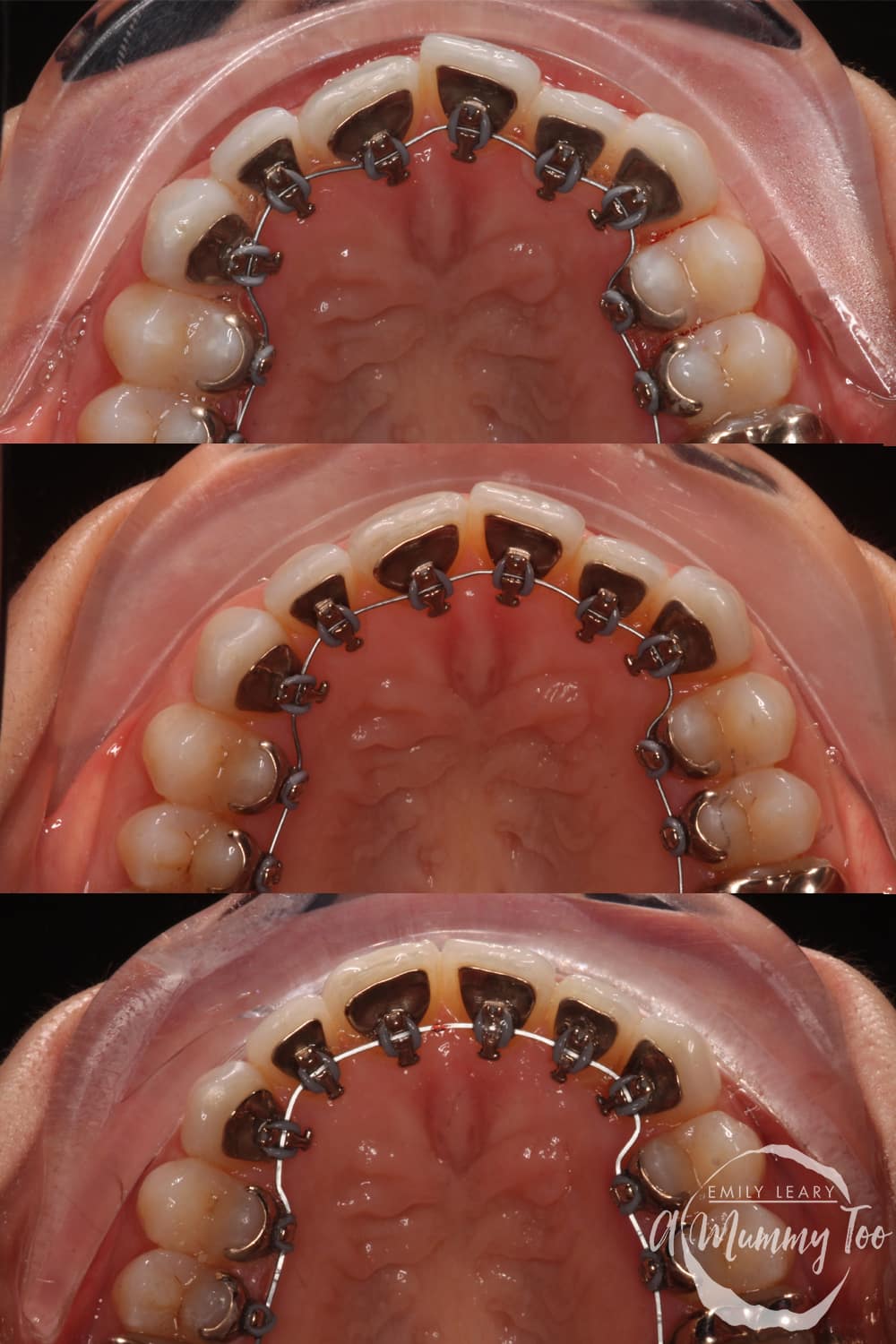 trio of images showing lingual braces in the roof of a mouth 