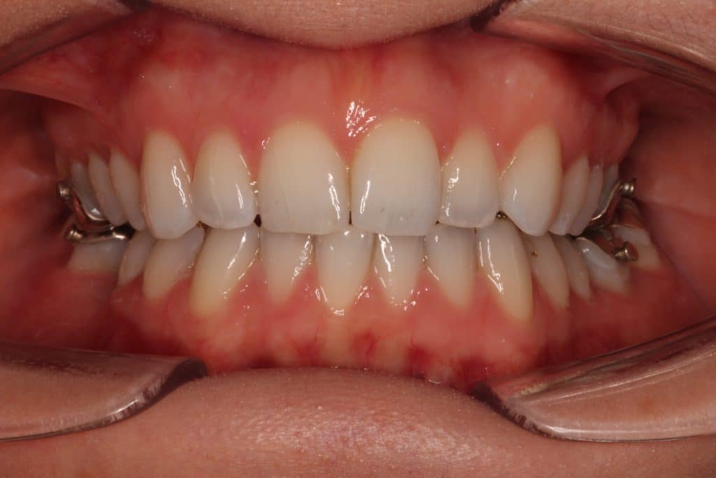 view of a mouth held open by a plastic guard showing straight white teeth.
