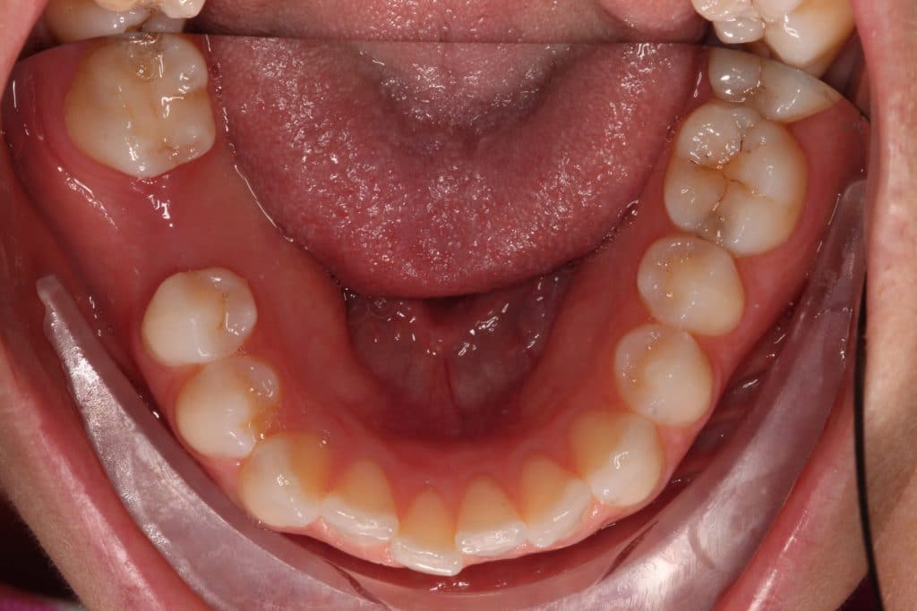 bottom teeth after using lingual braces