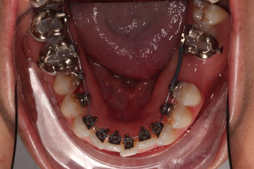 a view of the bottom teeth in a mouth with braces on the back.