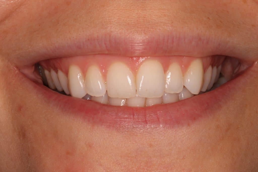 a mouth smiling with white straight teeth. 