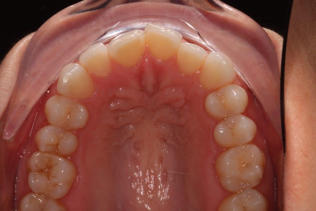 view of top teeth in a mouth after using lingual braces.