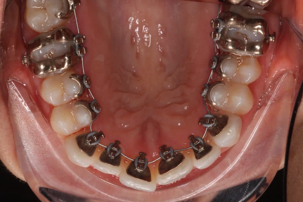a view of the top teeth in a mouth with braces on the back.