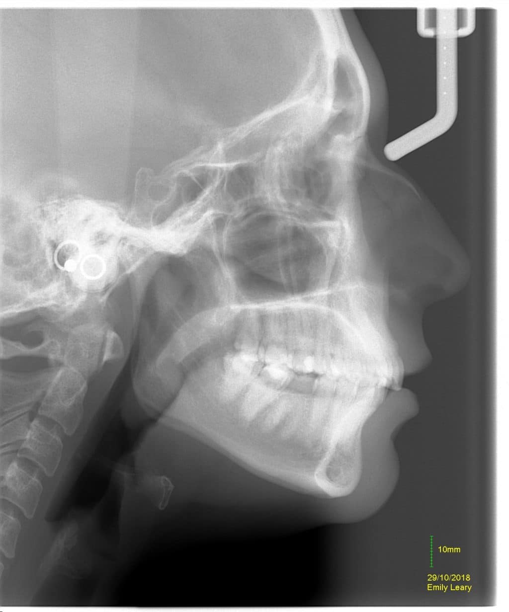 an x ray of a head showing the alignment of a jaw from the side.